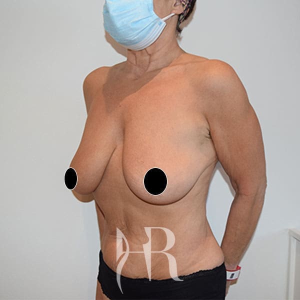 HR Plastic Surgery - Breast Reduction patient before 12